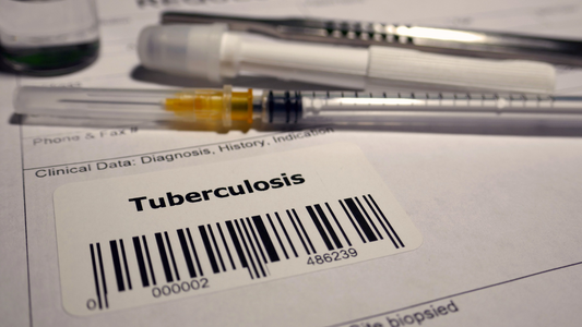 WHO opens new doors for fast TB testing across Africa